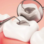 diş dolgusu tedavi, diş dolgusu nedir?, diş dolgusu fiyatları,