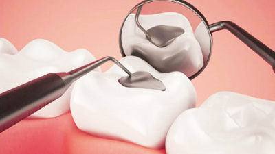 diş dolgusu tedavi, diş dolgusu nedir?, diş dolgusu fiyatları,