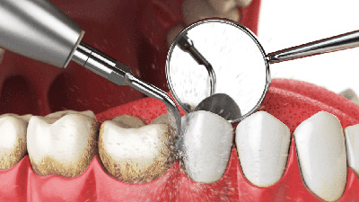 diş taşı temizliği tedavi, diş taşı temizliği nedir?, diş taşı temizliği fiyatları,