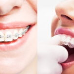 diş teli ortodonti tedavi, diş teli ortodonti nedir?, diş teli ortodonti fiyatları,