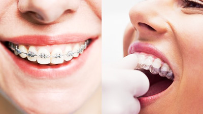 diş teli ortodonti tedavi, diş teli ortodonti nedir?, diş teli ortodonti fiyatları,