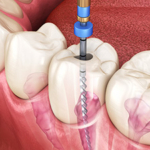 endodonti tedavi, endodonti nedir?, endodonti fiyatları,