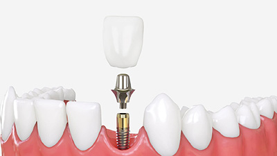 implant diş tedavi, implant diş tedavi nedir?, implant diş tedavi fiyatları,