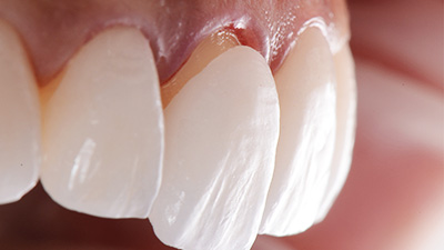 lamine diş tedavi, lamine diş tedavi nedir?, lamine diş tedavi fiyatları,