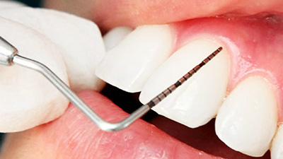 periodontoloji tedavi, periodontoloji tedavi nedir?, periodontoloji tedavi fiyatları,